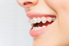 Woman`s smile with clear dental braces on teeth