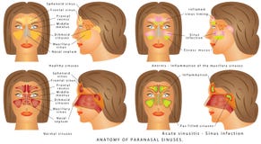 Varicocele testiculaire photo