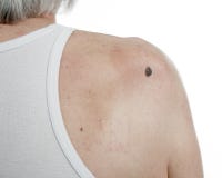 Skin Cancer In Men. Royalty Free Stock Photos