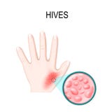 Skin rash. Hives or urticaria. Royalty Free Stock Photos Skin rash. Hives or urticaria. Royalty Free Stock Photos