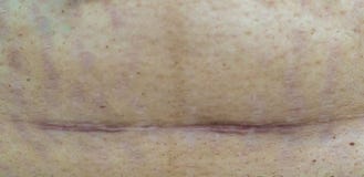 Slim and fit figure after the longitudinal caesarean section. Scar after a Caesarean section, Bikini line. Closeup of a scar on t stock photography Slim and fit figure after the longitudinal caesarean section. Scar after a Caesarean section, Bikini line. Closeup of a scar on t stock photography