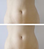Slimming : before-after
