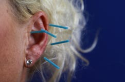 Sluit omhoog van menselijk vrouwelijk oor met blauwe naalden: Ooracupunctuur als vorm van alternatieve Chinese geneeskunde royalty-vrije stock afbeelding Sluit omhoog van menselijk vrouwelijk oor met blauwe naalden: Ooracupunctuur als vorm van alternatieve Chinese geneeskunde royalty-vrije stock afbeelding