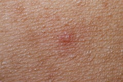 Soft Wounds on the skin Stock Photos Soft Wounds on the skin Stock Photos