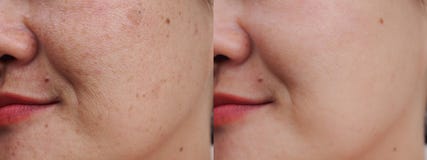 Before and after spot melasma treatment