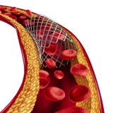 Stent-medizinisches Implantats-Konzept stock abbildung Stent-medizinisches Implantats-Konzept stock abbildung