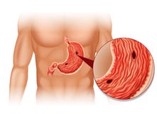 Stomach Ulcer in human body royalty free illustration Stomach Ulcer in human body royalty free illustration