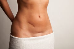 Stomach of a woman with scars