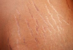 Stretch marks on the body stock photo Stretch marks on the body stock photo