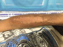 Sträng niacinbrist eller pellagra eller ljuskänslig dermatit i höger underarmen av den alkoholiserade vuxna patienten arkivbilder Sträng niacinbrist eller pellagra eller ljuskänslig dermatit i höger underarmen av den alkoholiserade vuxna patienten arkivbilder