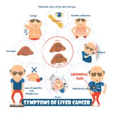 Symptoms of liver cancer vector illustration Symptoms of liver cancer vector illustration