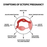 Symptômes de la grossesse ectopique Infographie Illustration de vecteur sur le fond d'isolement illustration libre de droits Symptômes de la grossesse ectopique Infographie Illustration de vecteur sur le fond d'isolement illustration libre de droits