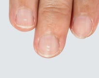 Taches blanches sur des ongles images libres de droits Taches blanches sur des ongles images libres de droits