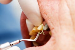 tand- gingival placerande sulcus för kabel royaltyfria foton tand- gingival placerande sulcus för kabel royaltyfria foton