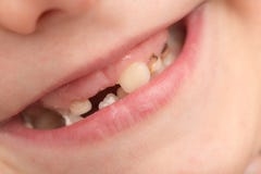 Teeth in children. close-up royalty free stock photos Teeth in children. close-up royalty free stock photos