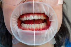 Teeth in the mouth at the dental clinic, the mouth is opened with a cheek retractor