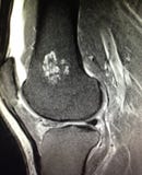 Knee pathology chondroid lesion enchondroma mri Stock Photography Knee pathology chondroid lesion enchondroma mri Stock Photography