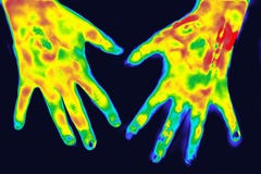 Thermographie in der Medizin stockbilder Thermographie in der Medizin stockbilder