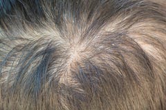 Thin hair and dandruff stock photography Thin hair and dandruff stock photography