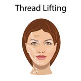 Thread lifting, vector illustration, before after effect Royalty Free Stock Image Thread lifting, vector illustration, before after effect Royalty Free Stock Image