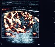 Thyroid nodule ultrasound