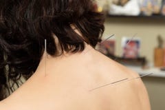 Tibetan medicine. Acupuncture, warming up royalty free stock photos Tibetan medicine. Acupuncture, warming up royalty free stock photos