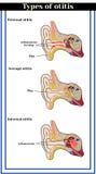 Tipos de otitis: otitis del externo, medio e interno stock de ilustración Tipos de otitis: otitis del externo, medio e interno stock de ilustración