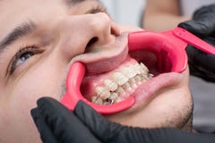 Tir en gros plan des dents blanches avec des accolades et du rétracteur dentaire au bureau dentaire photographie stock Tir en gros plan des dents blanches avec des accolades et du rétracteur dentaire au bureau dentaire photographie stock