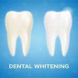 Tooth Veneer, Teeth Whitening, Whitening Toothpaste On A Background. Realistic Vector Illustration. royalty free illustration Tooth Veneer, Teeth Whitening, Whitening Toothpaste On A Background. Realistic Vector Illustration. royalty free illustration
