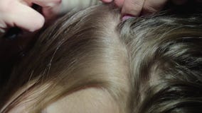 Traitement Du Pediculosis Principal Dans Un Enfant Retrait Des Lentes Et Poux Dans Les Cheveux De La Fille Clips Videos Video Du Blond Lente