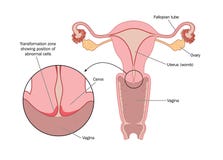 Transformation zone of cervix