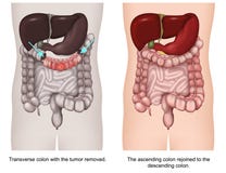 Transverse colectomy 3d medical vector illustration vector illustration Transverse colectomy 3d medical vector illustration vector illustration