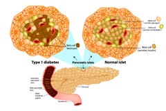 Type 1 diabetes Beta cell destroyed. stock illustration Type 1 diabetes Beta cell destroyed. stock illustration