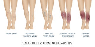 Types of varicose veins in women.