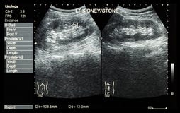 Ultrasonography of kidney : show left kidney stone ( 2 image for compare ) royalty free stock photography Ultrasonography of kidney : show left kidney stone ( 2 image for compare ) royalty free stock photography