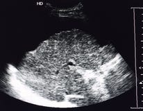 Ultrasound image of liver cirrhosis