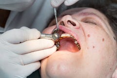 Un dentiste fait des dents à une femme photos libres de droits Un dentiste fait des dents à une femme photos libres de droits