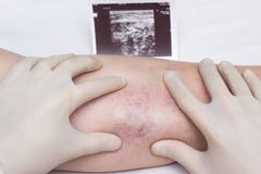 Un docteur dans les gants examine les veines et les jambes du patient pour la présence de la thrombose et des veines variqueuses images stock Un docteur dans les gants examine les veines et les jambes du patient pour la présence de la thrombose et des veines variqueuses images stock