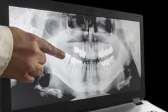 Un rayon X de dents avec une main de docteur images stock Un rayon X de dents avec une main de docteur images stock