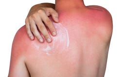 Un uomo con pelle che prude arrossita dopo la solarizzazione, crema delle sbavature sulla pelle Fotografia Stock Libera da Diritti Un uomo con pelle che prude arrossita dopo la solarizzazione, crema delle sbavature sulla pelle Fotografia Stock Libera da Diritti