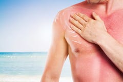 Uomo con pelle nociva dal sole, solarizzazione Fotografie Stock Uomo con pelle nociva dal sole, solarizzazione Fotografie Stock