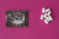 Uzi brzemienność na różowym tle i pigułkach, aborcja płód obrazy stock Uzi brzemienność na różowym tle i pigułkach, aborcja płód obrazy stock