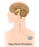 Vagusnerven-Anregungtherapie vektor abbildung Vagusnerven-Anregungtherapie vektor abbildung