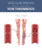 Vascular diseases. Vein thrombosis symptoms, treatment icon set. Vector Illustration Vascular diseases. Vein thrombosis symptoms, treatment icon set. Vector Illustration