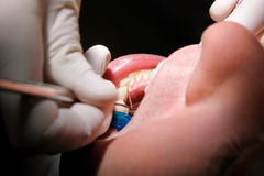Verificação dental acima O controle dental com ferramentas dentais sonda, espelho e tubo de sução na boca O dentista é exame dos imagens de stock Verificação dental acima O controle dental com ferramentas dentais sonda, espelho e tubo de sução na boca O dentista é exame dos imagens de stock
