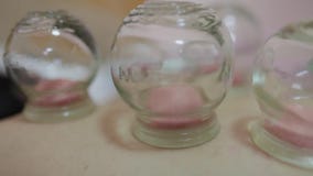 View of Chinese cupping therapy , Tianjin, China stock video footage View of Chinese cupping therapy , Tianjin, China stock video footage
