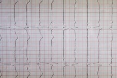 Vista ascendente cercana de un papel del electrocardiograma, gráfico imagen de archivo Vista ascendente cercana de un papel del electrocardiograma, gráfico imagen de archivo