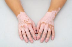 Vitiligo on skin of hands
