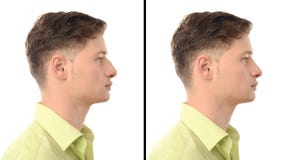 Vorher-Nachher-Foto eines jungen Mannes mit Nasenoperationsplastischer chirurgie. lizenzfreie stockfotos Vorher-Nachher-Foto eines jungen Mannes mit Nasenoperationsplastischer chirurgie. lizenzfreie stockfotos