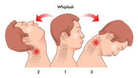 Wadenmuskelriss Wadenmuskelriss